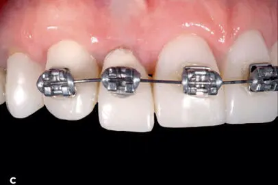 Fig 126 Orthodontic extrusion can be used to establish an optim - фото 106