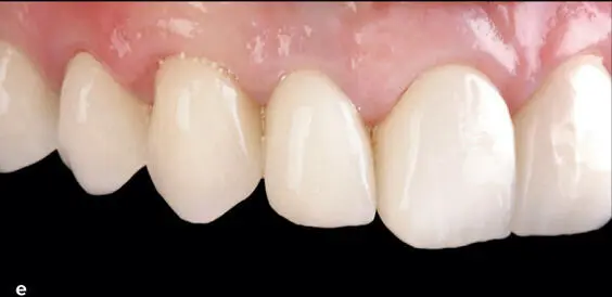 Fig 126 Orthodontic extrusion can be used to establish an optimal ferrule - фото 108