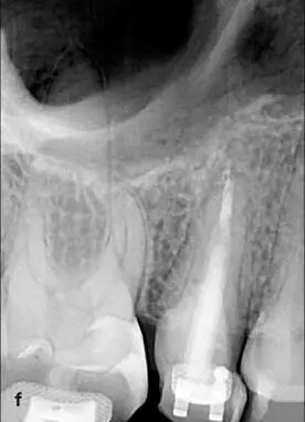 Fig 124 a and b Orthodontic extrusion can be used to - фото 98