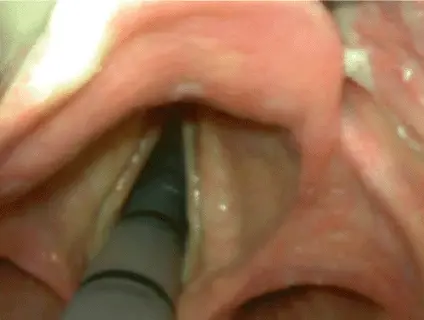 Abb A21b Durchtritt des Endotrachealtubus unter videolaryngoskopischer Sicht - фото 14