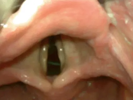 Abb A21a Einstellung der Stimmbandebene mittels eines Videolaryngoskopes und - фото 13