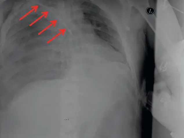 Abb B12 Spannungshämatopneumothorax rechts Z n Anlage eines - фото 30