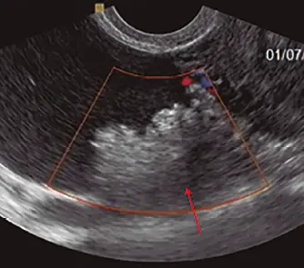 Fig 10 Fig 10 imagen papilar flecha dentro de una formación quística - фото 31