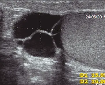 Fig 7 Fig 7 corte longitudinal a nivel de cabeza de epidídimo izquierdo se - фото 27