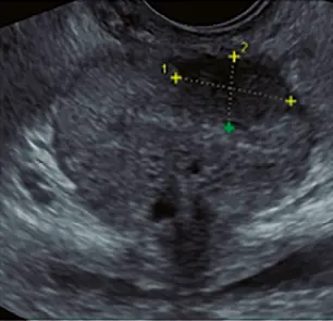 Fig 12 Fig 12 corte axial por vía transrectal en módulo ginecológico de la - фото 33