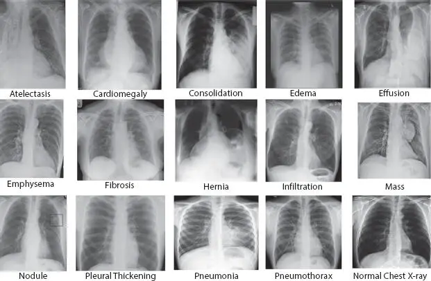 Figure 22 Types of chest pathologies Detection of Cardiomegaly is done by - фото 8