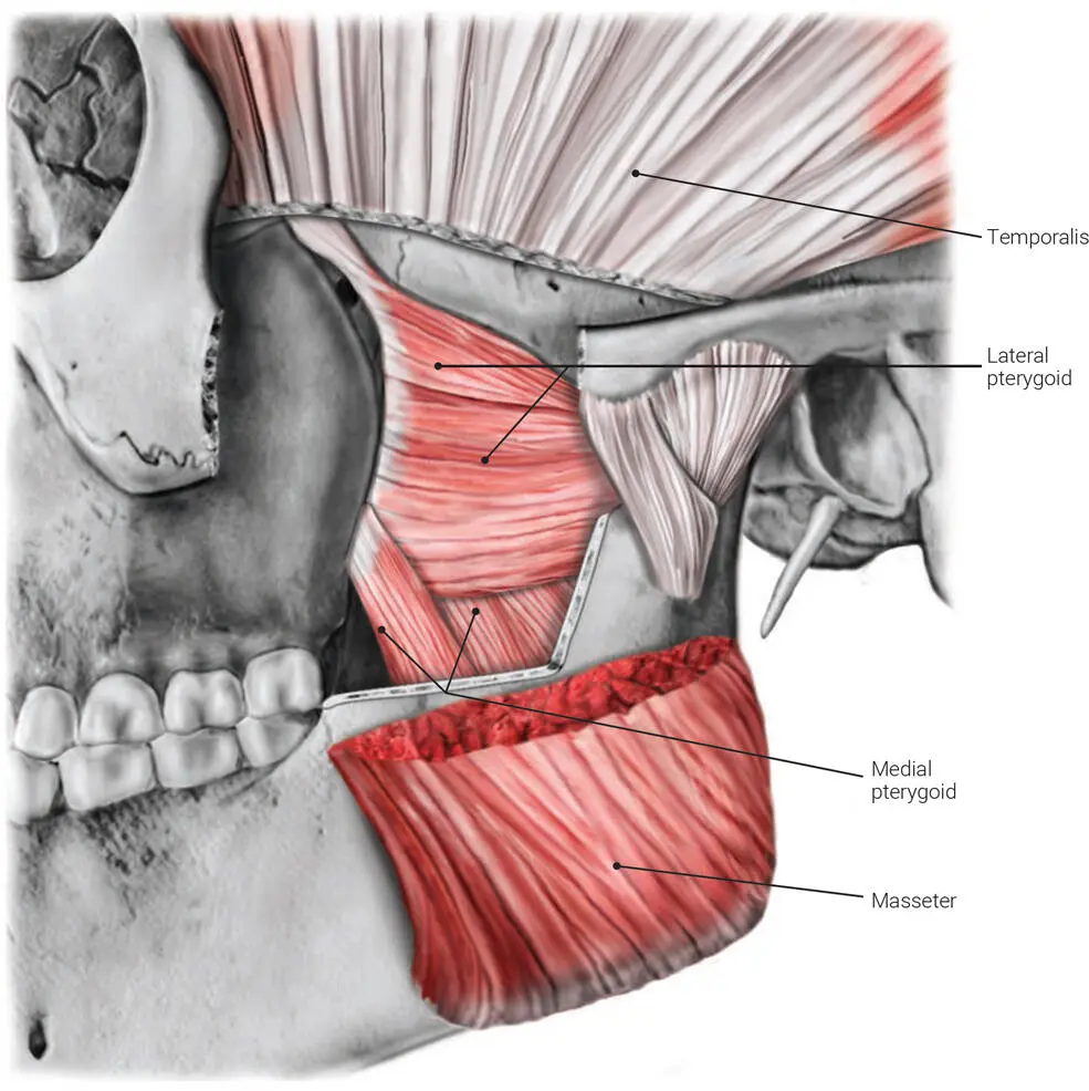 FIG 27 Lateral view of insertion of the lateral pterygoid muscle FIG 28 - фото 26
