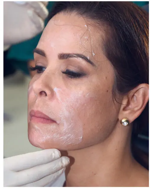 FIG 25A topical anesthetic cream will generally take effect within about 5 - фото 19