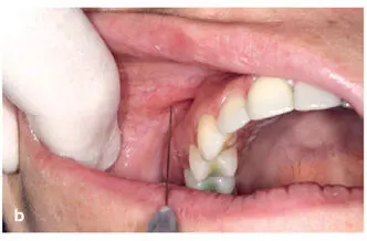 FIG 211 a to c Ring block method for upper lip The black circles denote the - фото 27