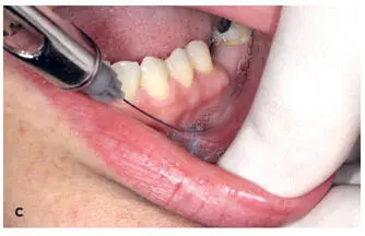 FIG 212 a to c Ring block method for lower lip The black circles denote the - фото 31