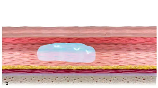 FIG 16Other dermal filler products are designed to add volume to sunken skin - фото 12