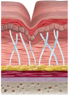 FIG 15Some dermal filler products stimulate the production of collagen and - фото 9