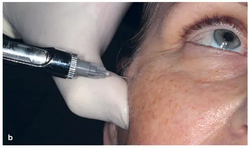 FIG 29 a and b Administration of local anesthetic for dermal filler - фото 24