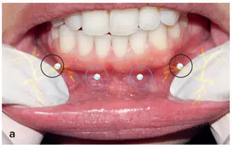 FIG 212 a to c Ring block method for lower lip - фото 29