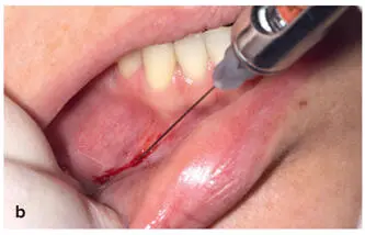 FIG 212 a to c Ring block method for lower lip The black circles denote the - фото 30