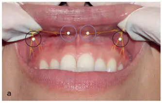 FIG 211 a to c Ring block method for upper lip - фото 26