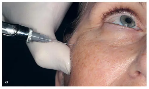 FIG 29 a and b Administration of local anesthetic for dermal filler - фото 23
