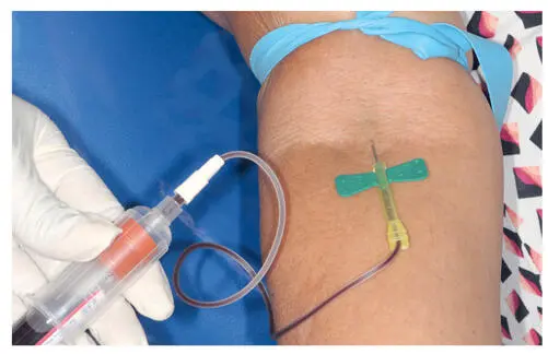 FIG 311PRP requires a venipuncture to draw the patients blood but eliminates - фото 44