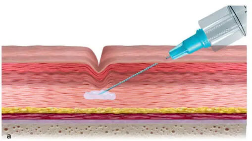 FIG 16Other dermal filler products are designed to add volume to sunken skin - фото 11