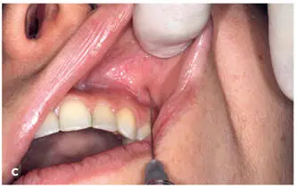 FIG 211 a to c Ring block method for upper lip The black circles denote the - фото 28