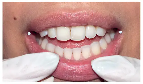 FIG 210Ring block method for corners of lips The white dots denote the - фото 25