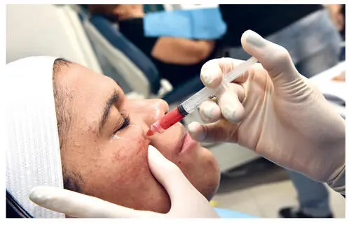 FIG 310Application of PRP through a needleless syringe following microneedling - фото 43
