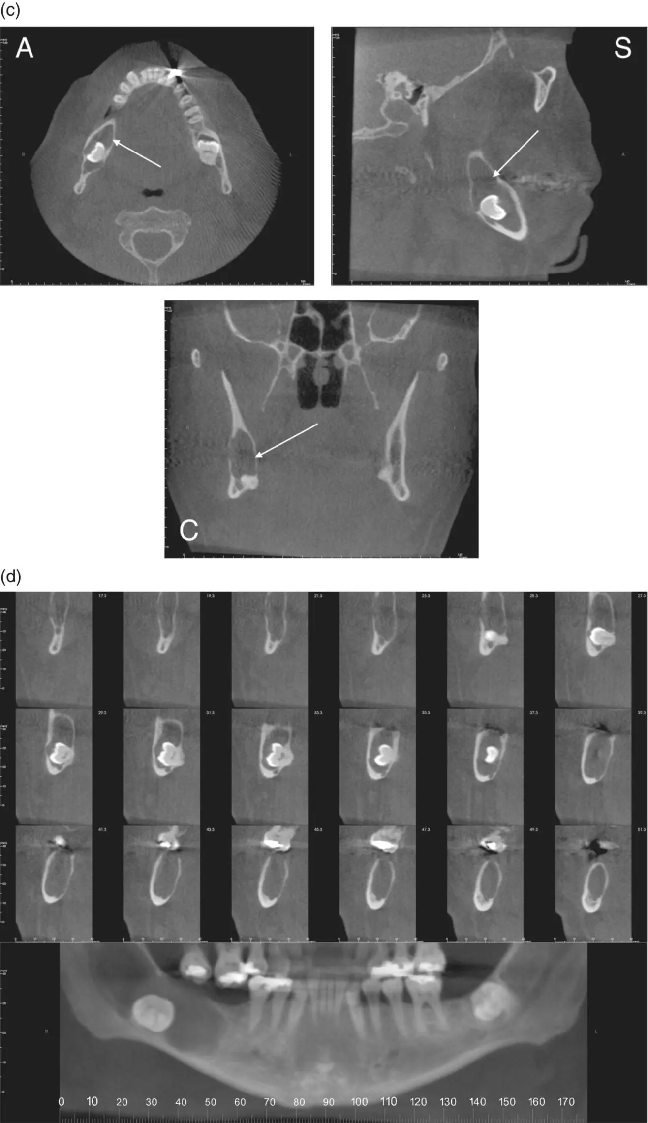 Figure 216 a Bitewing radiographs showing bone loss white arrow in the - фото 39