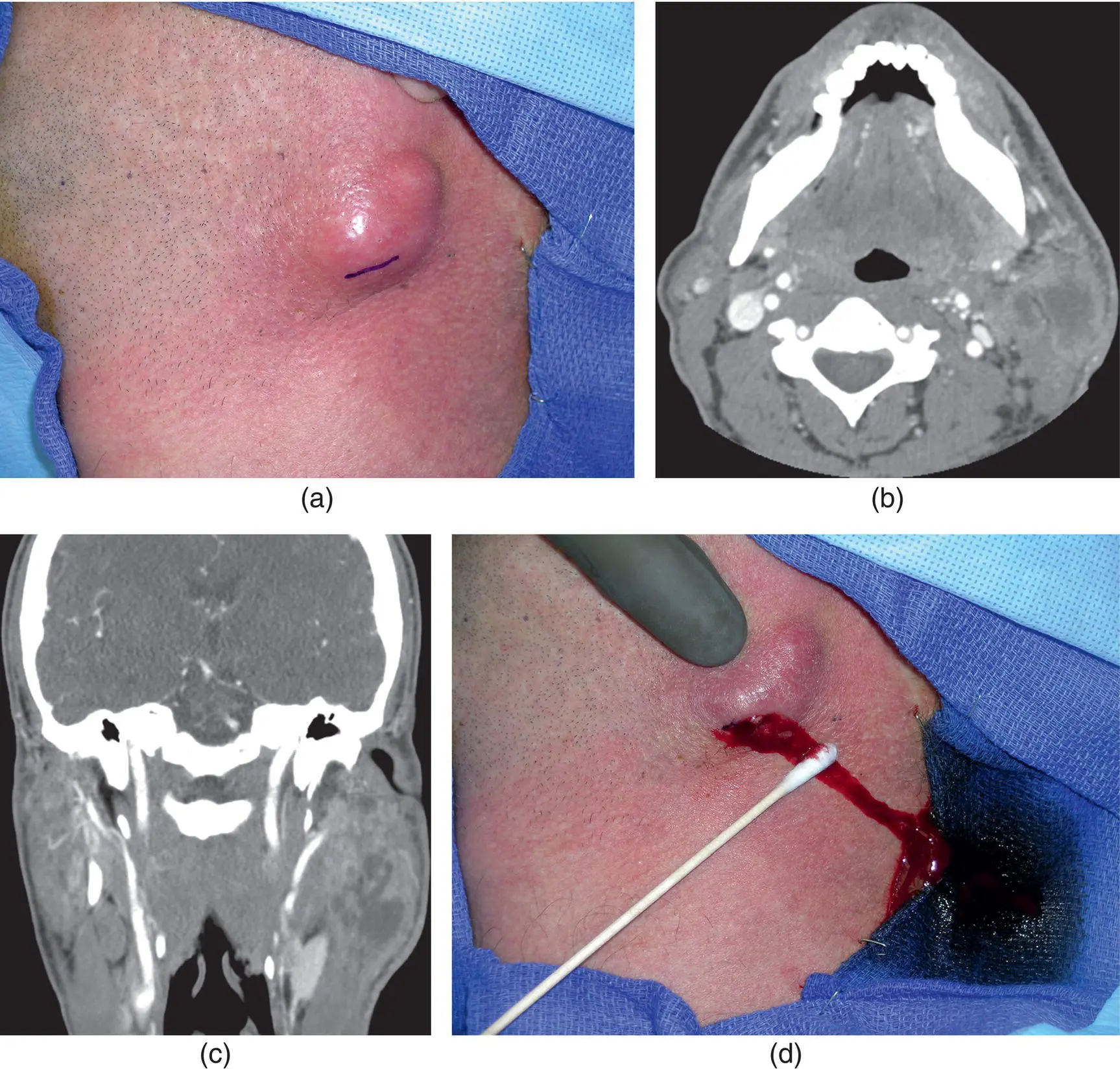 Figure 39 A left facial abscess in a 45yearold man with a twoweek history - фото 119