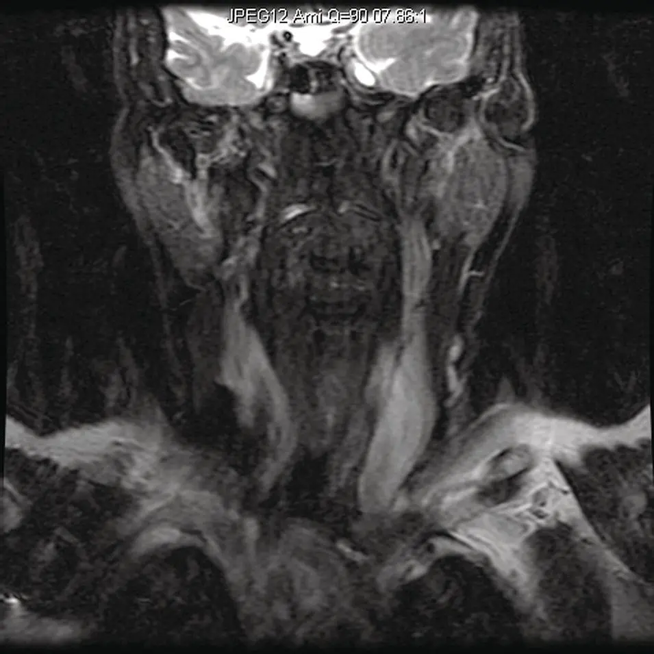 Figure 234Coronal STIR MRI image at the level of the parotid gland - фото 54