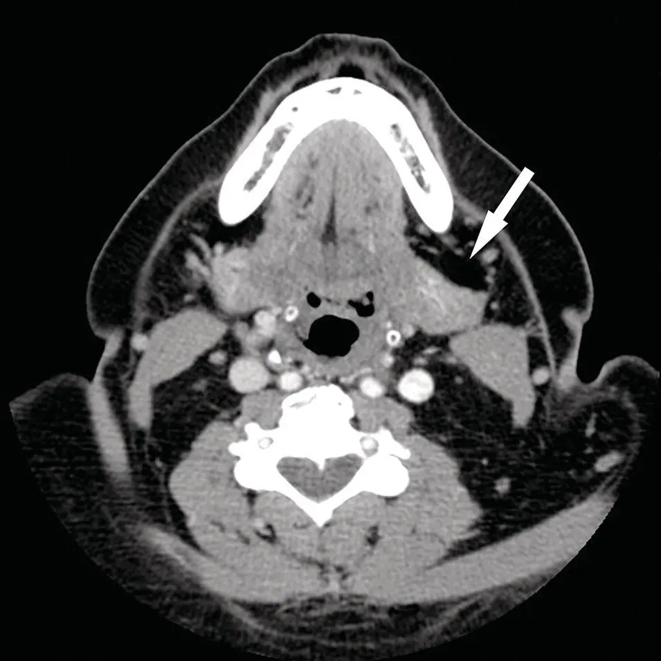 Figure 22 Axial CT of the neck in softtissue window with IV contrast - фото 22