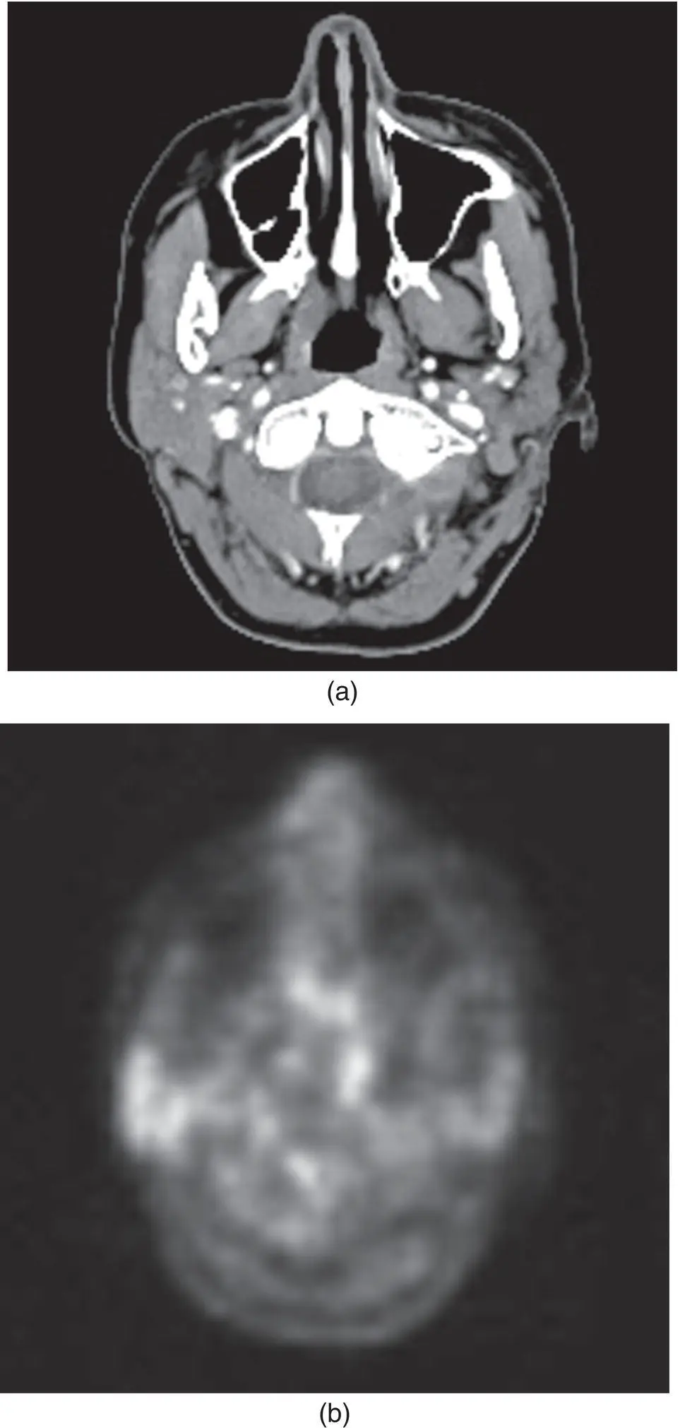 Figure 236 Axial CT scan a and corresponding PET scan b at the level of - фото 56
