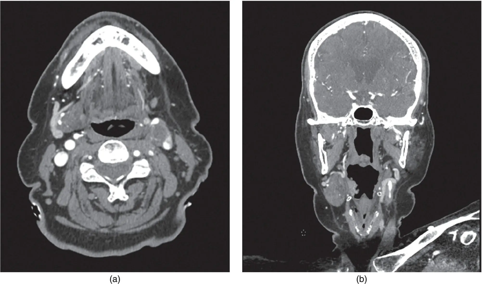 Figure 115 Axial a and coronal b CT angiogram of the neck demonstrating - фото 20
