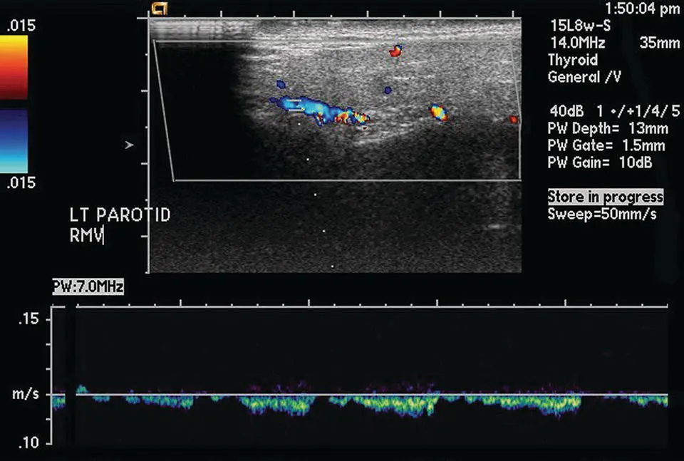 Figure 219 Ultrasound of the parotid gland in longitudinal orientation - фото 39