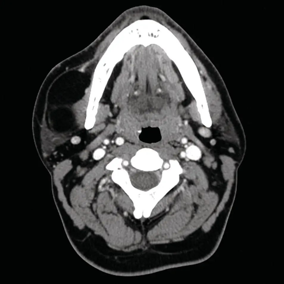 Figure 272 Axial contrastedenhanced CT of the head with a fat density mass - фото 92