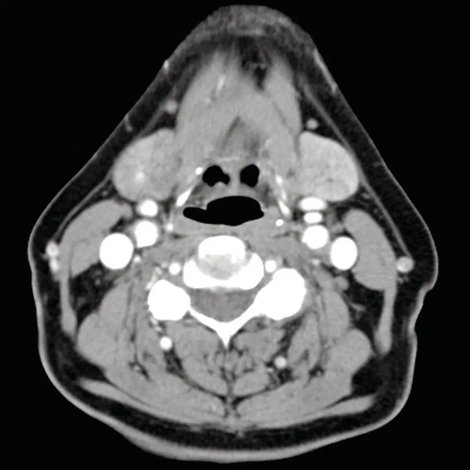 Figure 237 Axial CT at the level of the submandibular gland demonstrating - фото 57