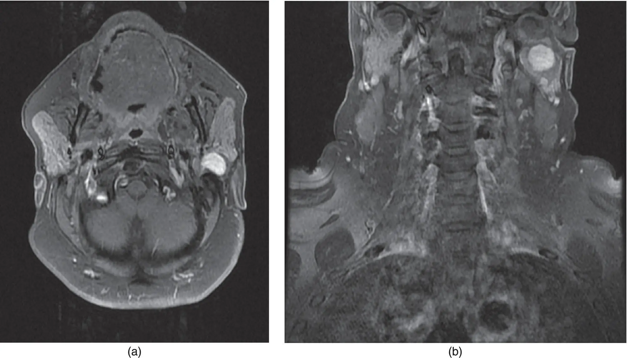 Figure 213 Axial a and coronal b MRI T1 postcontrast fat saturated image - фото 33