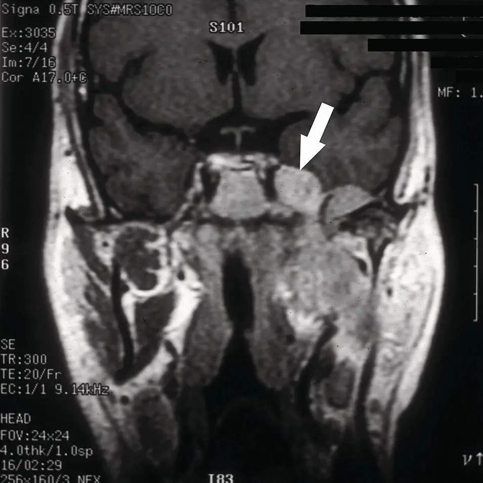 Figure 267 Coronal contrastenhanced MRI of the skull base demonstrating a - фото 87