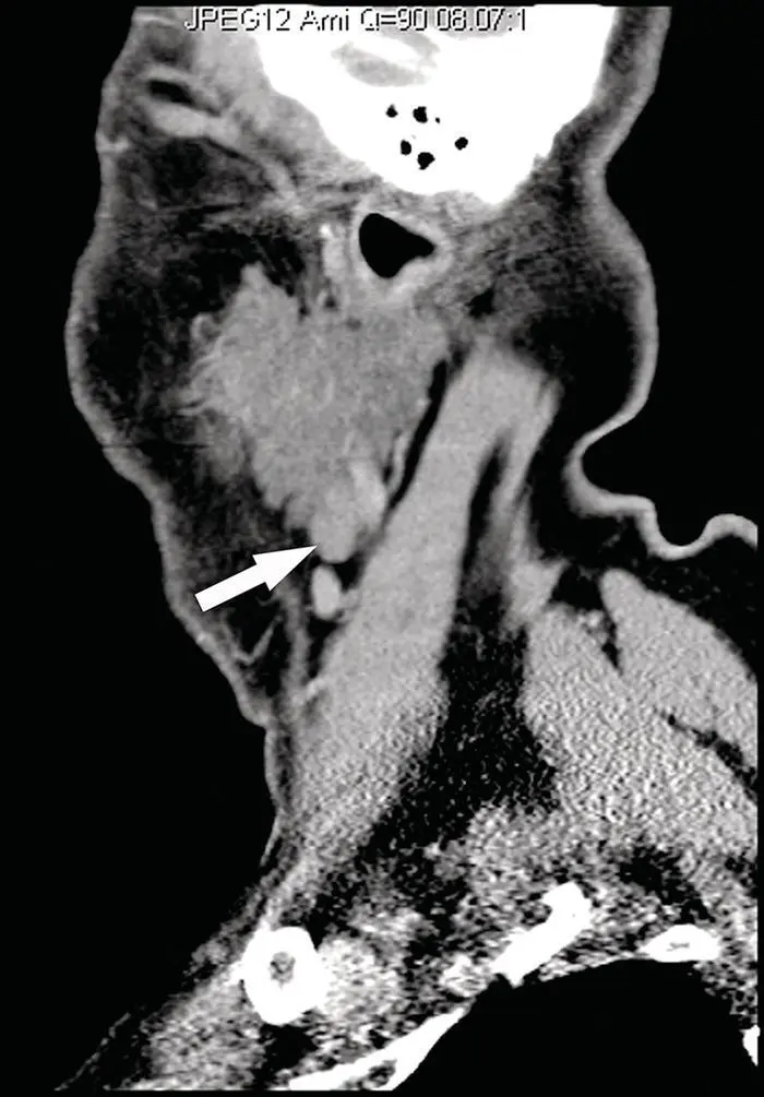 Figure 232Reformatted sagittal CT of the neck at the level of the parotid - фото 52