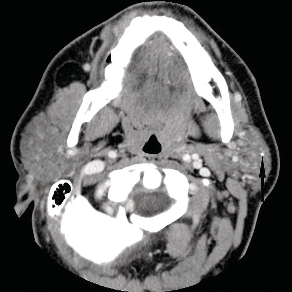 Figure 257Axial contrastenhanced CT of the parotid gland demonstrating a - фото 77