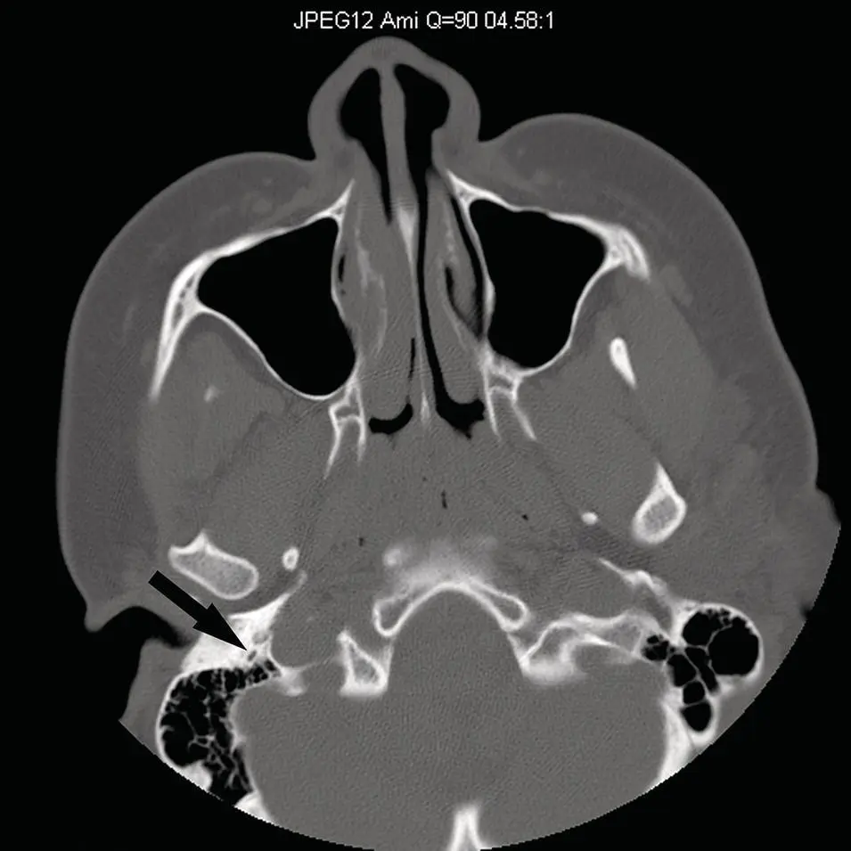 Figure 23 Axial CT of the skull base reconstructed in a sharp algorithm and - фото 23