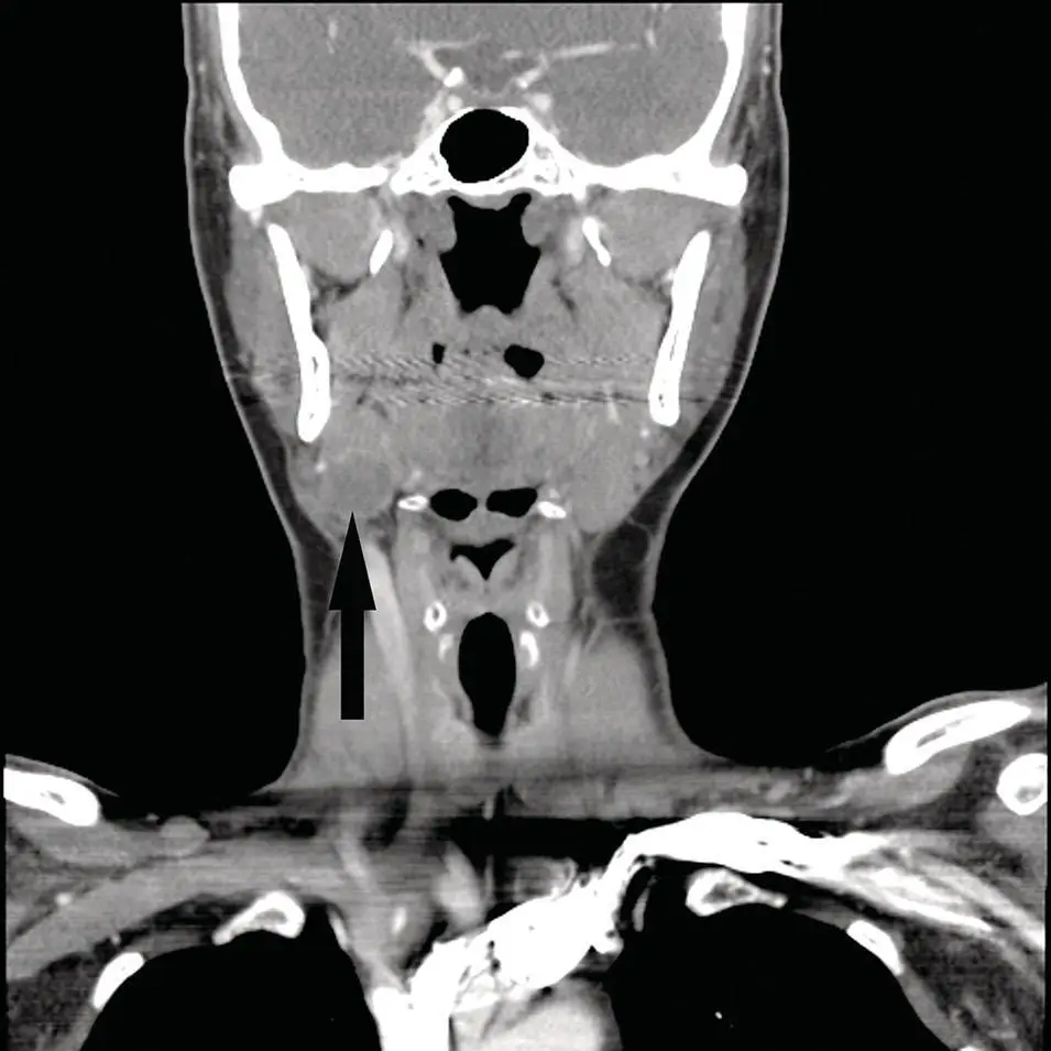 Figure 270Reformatted contrastenhanced coronal CT with a mass in the right - фото 90