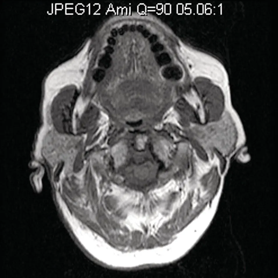 Figure 233Axial T1 MRI image at the level of the parotid gland demonstrating - фото 53