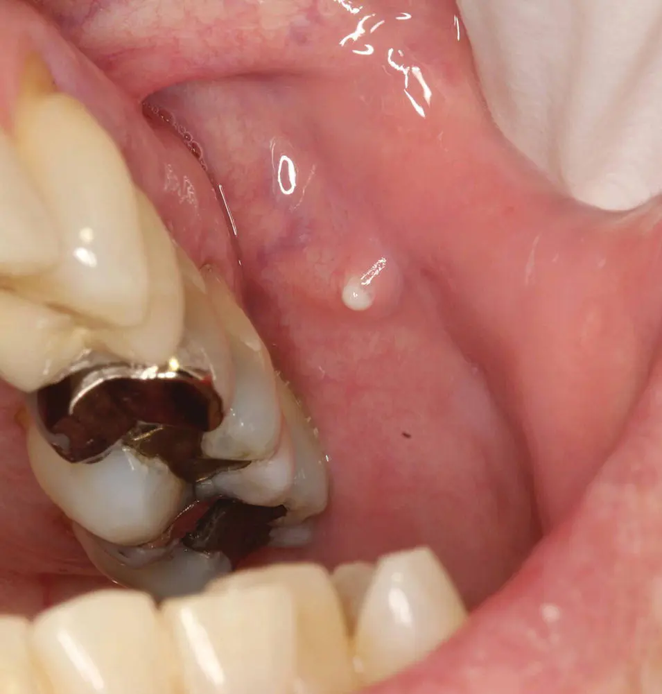 Figure 35 A mild case of community acquired parotitis is noted by the - фото 115