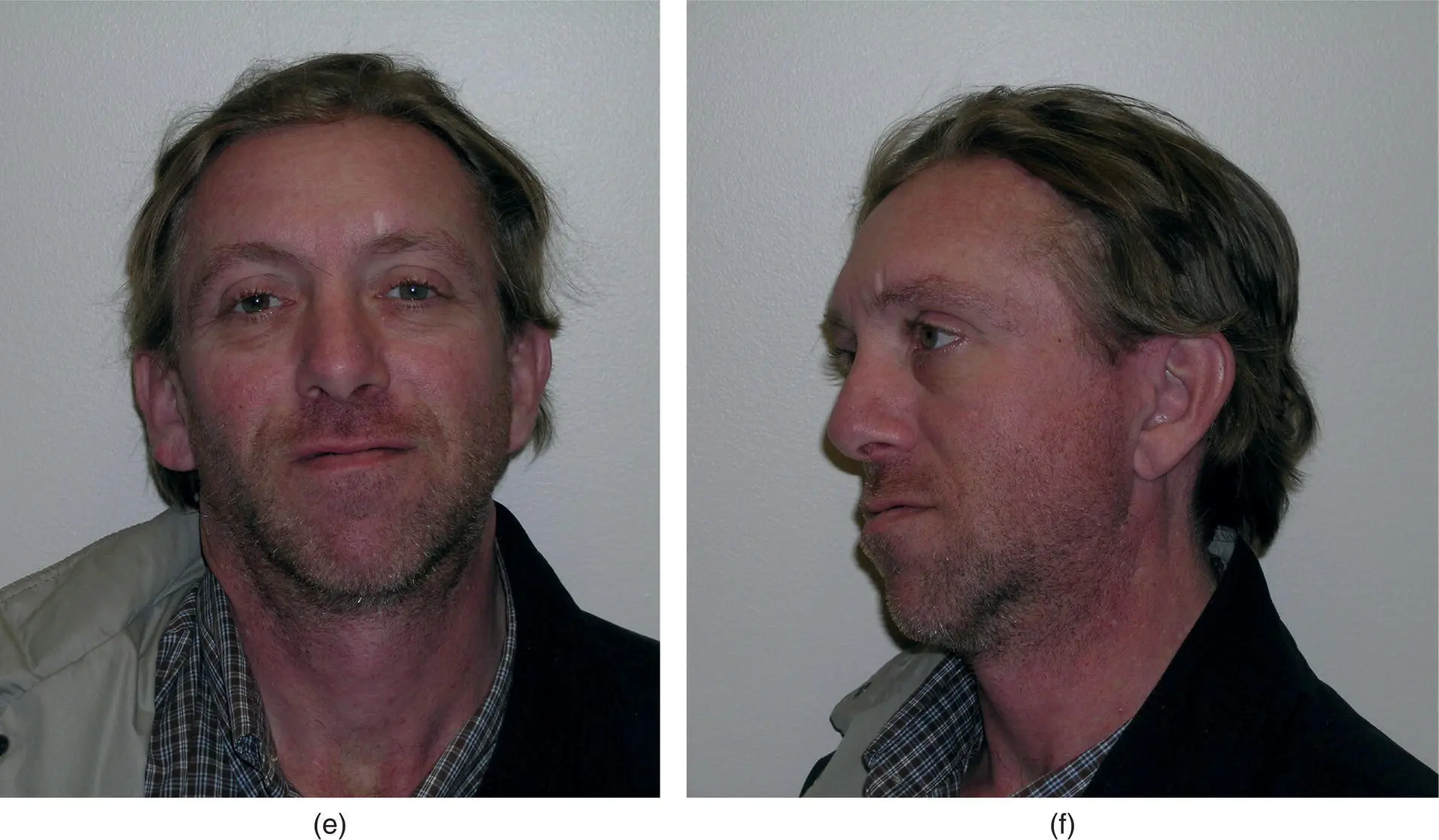 Figure 39 A left facial abscess in a 45yearold man with a twoweek history - фото 120