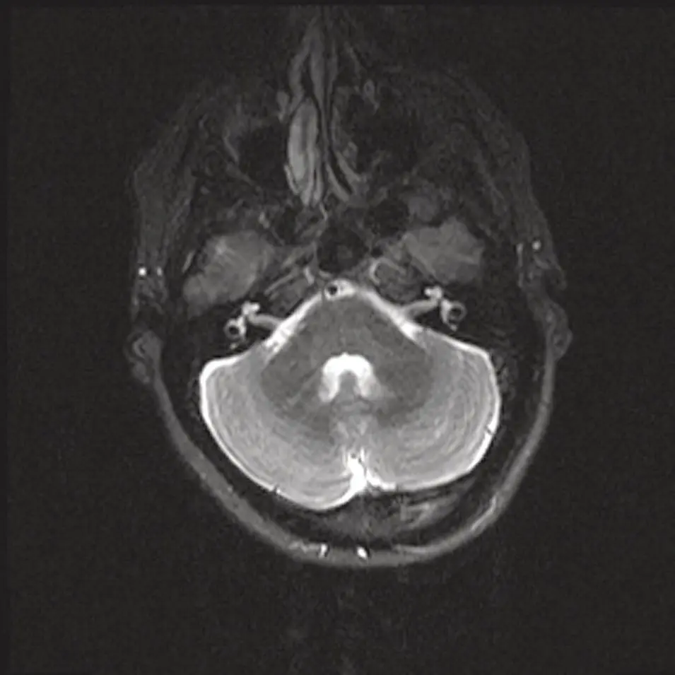 Figure 211 Axial MRI STIR image at the skull base demonstrating the high - фото 31