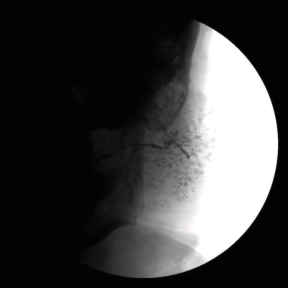 Figure 223 Parotid sialogram Note the punctate filling areas without ductal - фото 43