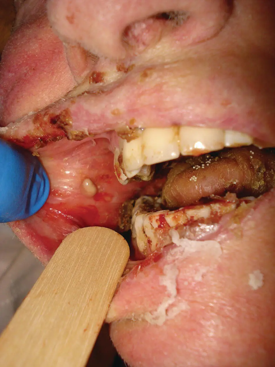 Figure 34 A severe case of hospital acquired parotitis related to - фото 114
