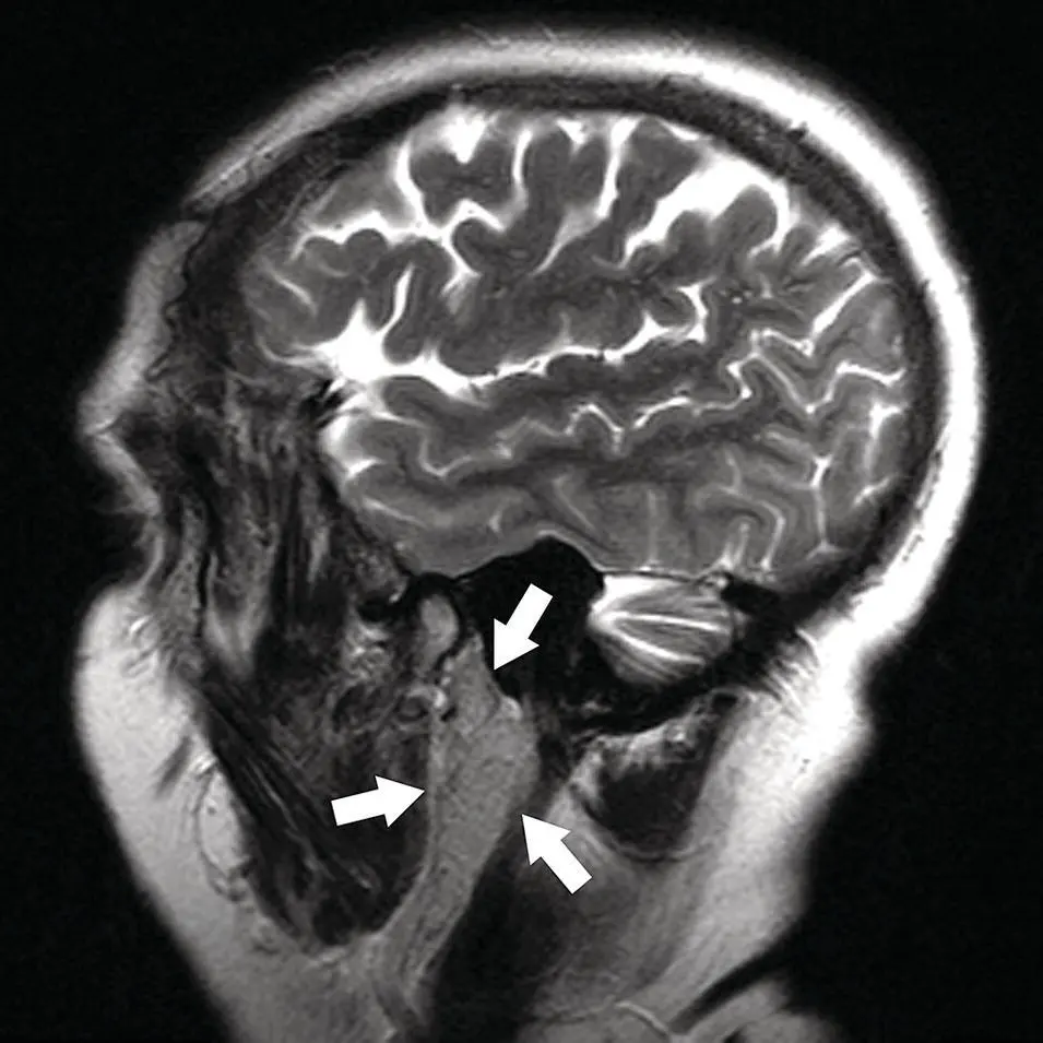 Figure 212 Sagittal MRI STIR image at the level of the parotid gland - фото 32