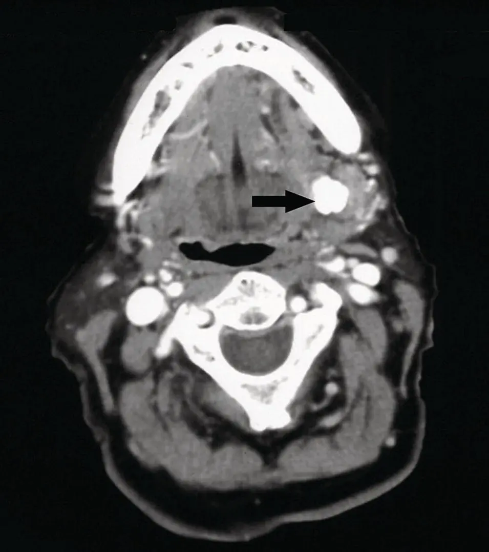 Figure 258 Axial contrastenhanced CT at the level of the submandibular - фото 78