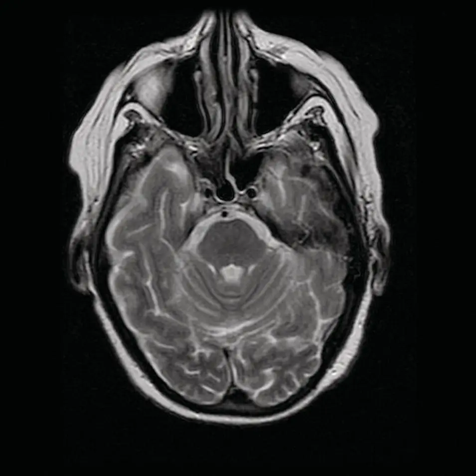 Figure 29 Axial MRI FSE T2 weighted image demonstrating the high signal of - фото 29